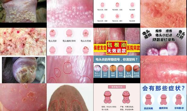 汕头鬼头炎症