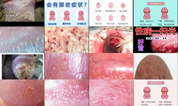 汕头龟头炎症图片