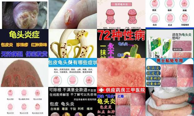 汕头霉菌性龟头炎症状表现