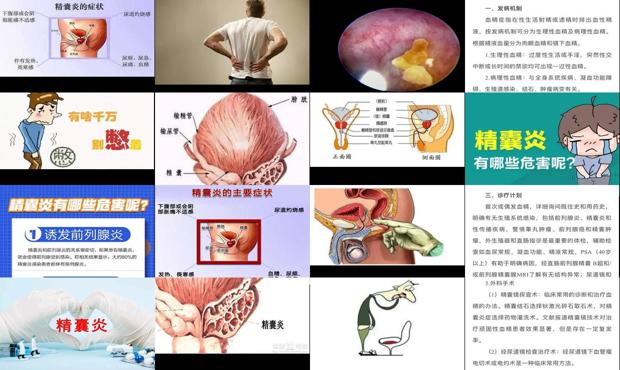 汕头精囊炎症状表现有哪些