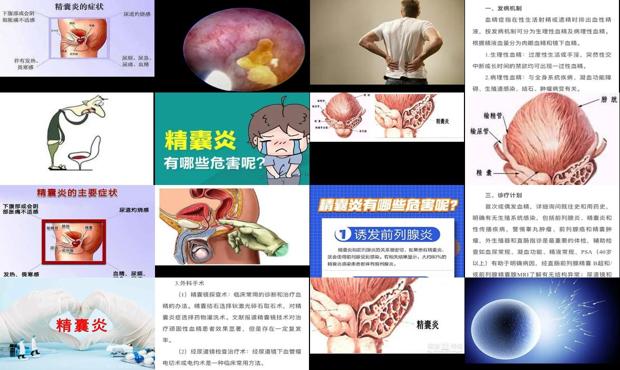 汕头精囊炎症状