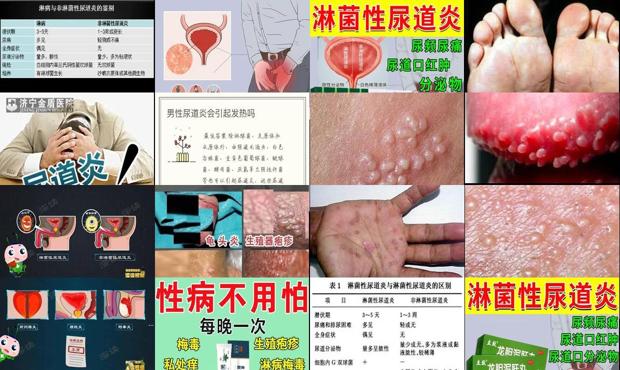 汕头淋球菌尿道炎症状