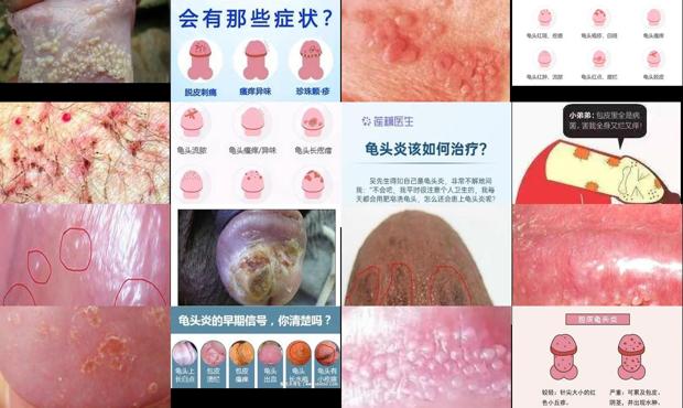 汕头龟头有炎症