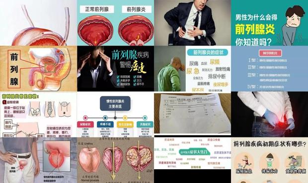 汕头急性前列腺炎症状是什么表现