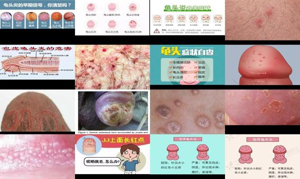 汕头龟头炎症状图片