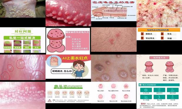 汕头龟头炎症状表现