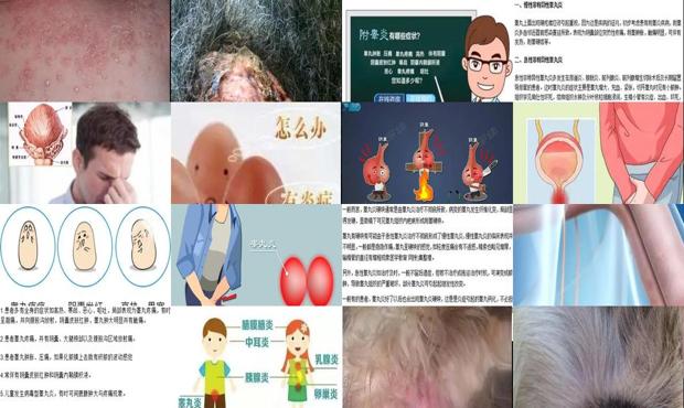 汕头睾丸炎症状的图片图库
