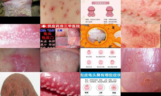 汕头包皮龟头炎症