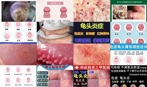 汕头霉菌龟头炎症状