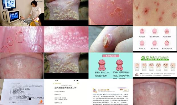 汕头男人龟头炎症状图片