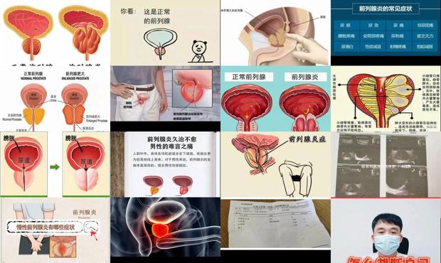 汕头如何判断自己前列腺炎