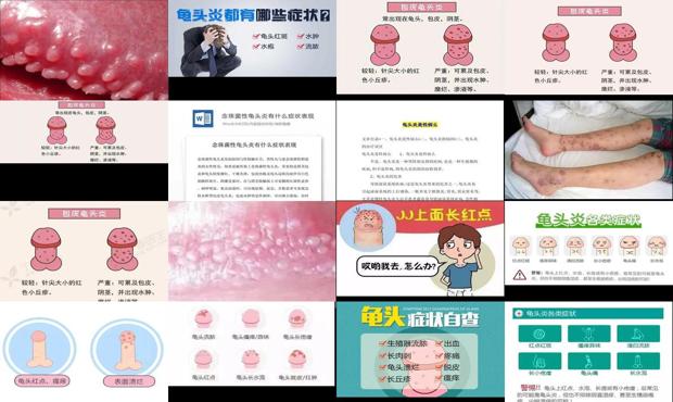 汕头龟头炎症状表现有哪些