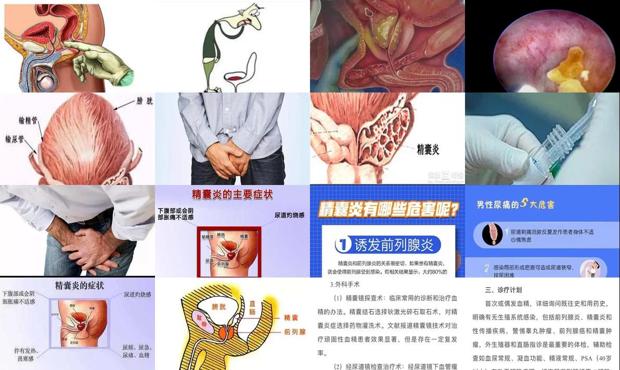 汕头精囊炎症状的表现