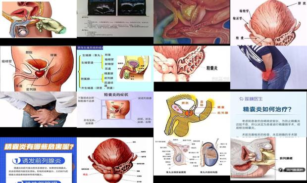 汕头前列腺精囊炎