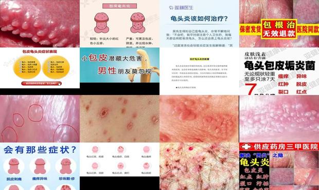 汕头龟头下炎症