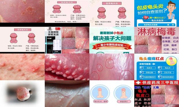 汕头男性包皮炎症状