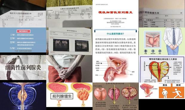 汕头慢性非细菌性前列腺炎