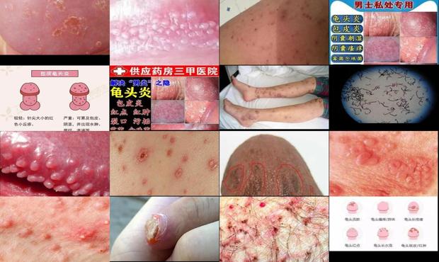 汕头霉菌性龟头炎症状图片