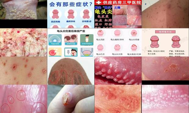 汕头龟头炎症感染