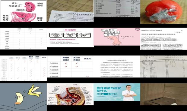 汕头男性霉菌性尿道炎症状