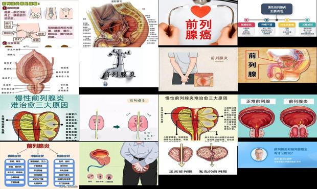汕头前列腺炎症状图