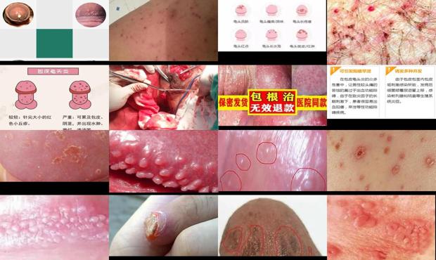汕头龟头炎症图片大*