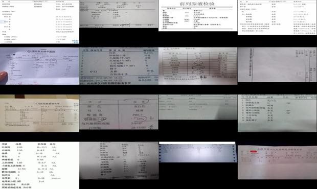 汕头前列腺液检查正常标准
