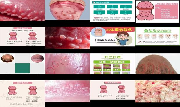 汕头龟头炎症状区分