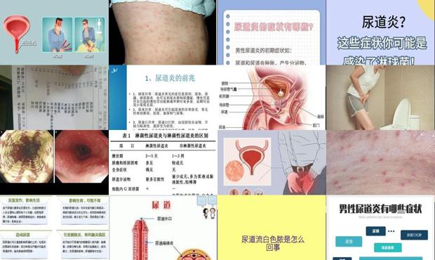 汕头男性慢性尿道炎症状表现