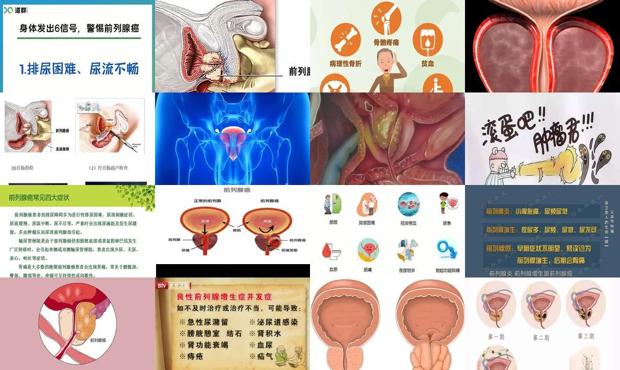汕头前列腺*的症状