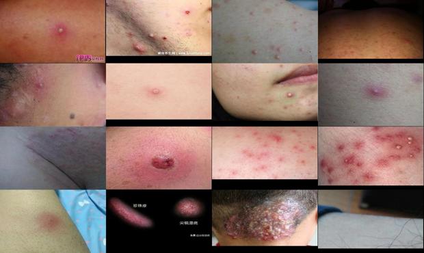汕头男性阴毛囊炎症状