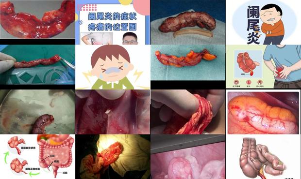 汕头阑尾炎症状