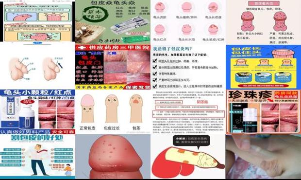 汕头包皮内有炎症