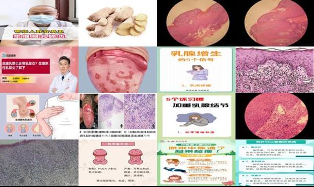 汕头浆细胞性龟头炎症状
